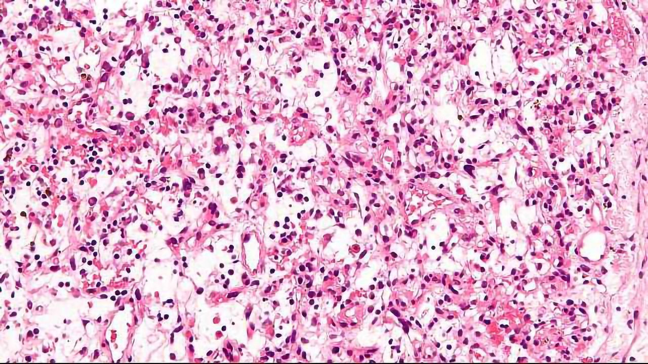 Predicting the Response to Immunotherapy Using Artificial Intelligence
