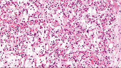 Predicting the Response to Immunotherapy Using Artificial Intelligence