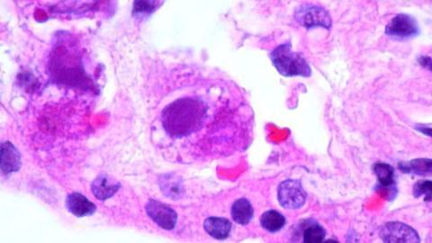 New Antiviral Targets Uncovered in Herpesvirus Study