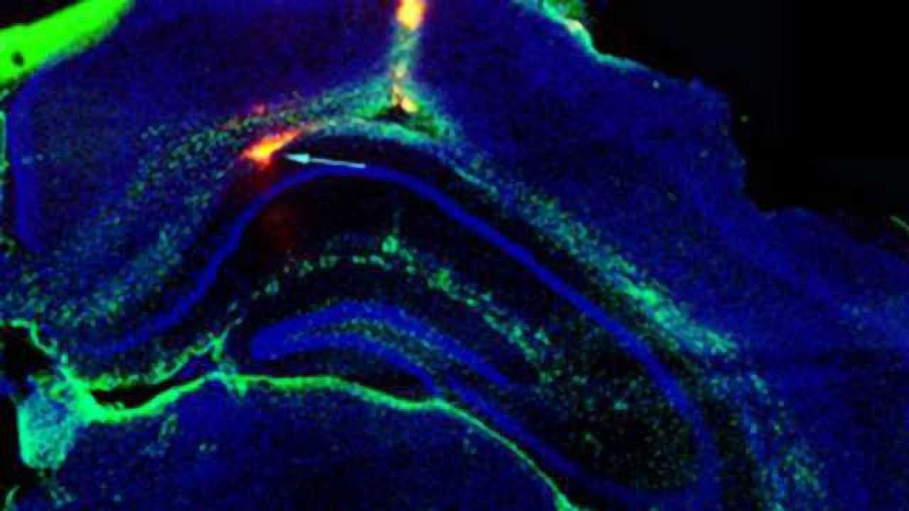 Electronic Device Planted in Brain Could Stop Seizures