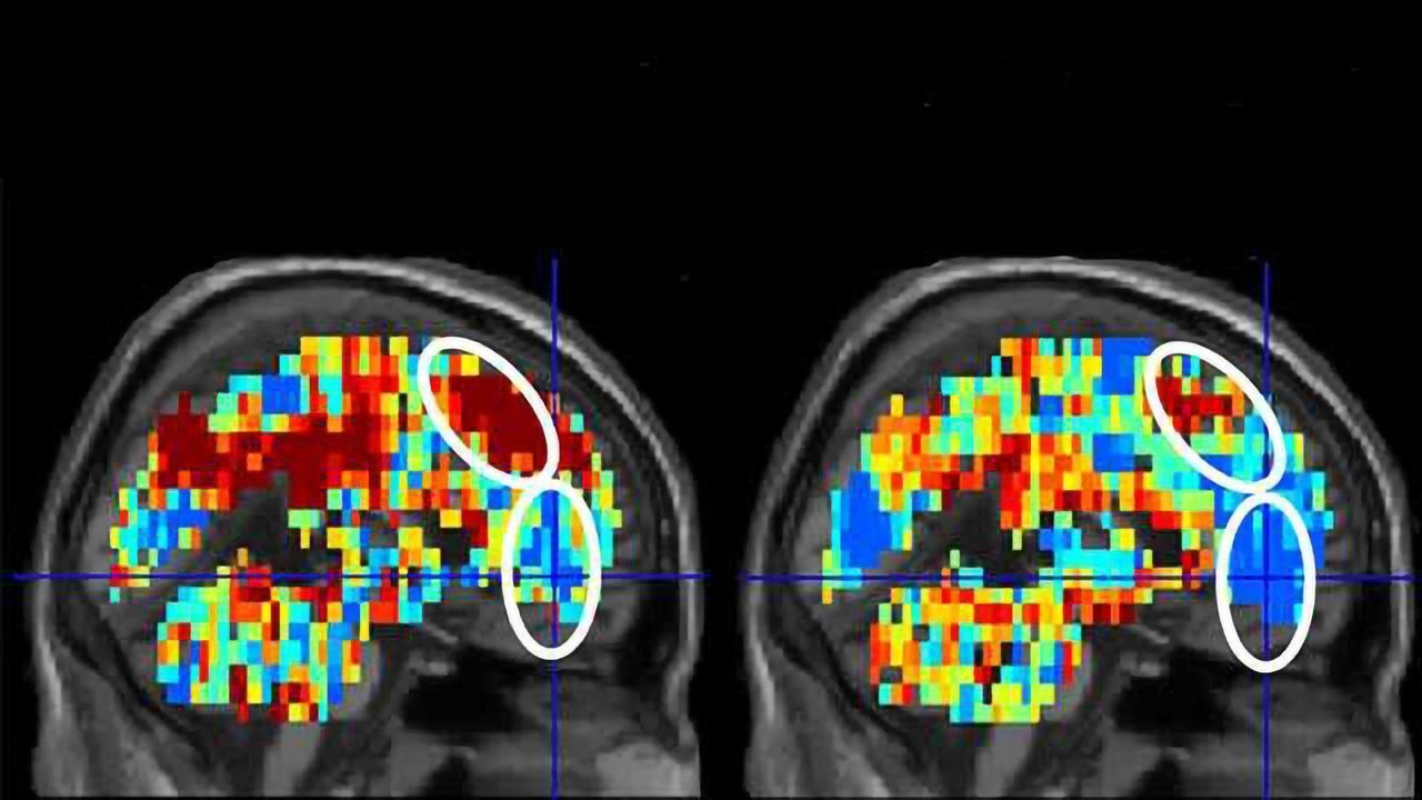 $3.8M NIMH Grant To Diagnose Suicidal Thinking Using Brain Imaging