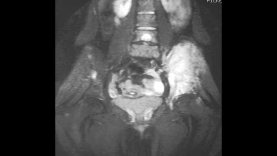 Children’s Bone Cancers Could Remain Hidden for Years Before Diagnosis content piece image