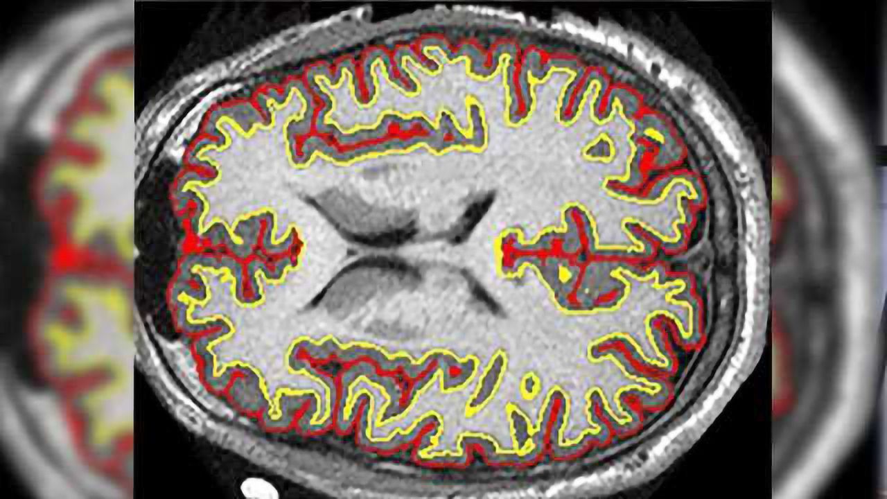 Multiple Sclerosis Drug Slows Brain Shrinkage