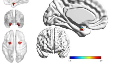 Looking Inside the Brain to Distinguish Bipolar from Depression
