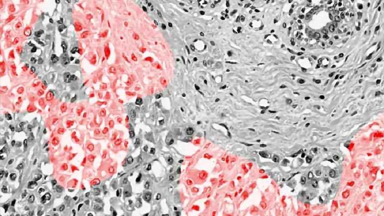 A New Way to Identify Breast Cancer Tumors