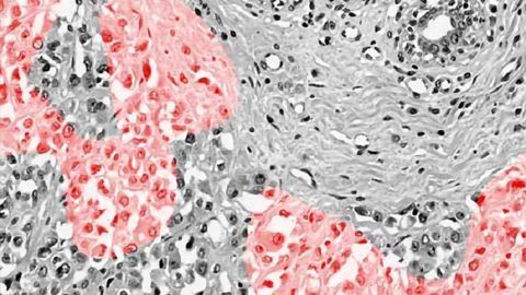 A New Way to Identify Breast Cancer Tumors