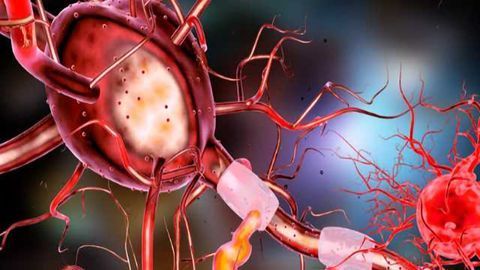 Study Shows How Exercise Generates new Neurons and Improves Cognition in an Alzheimer's Mouse Model