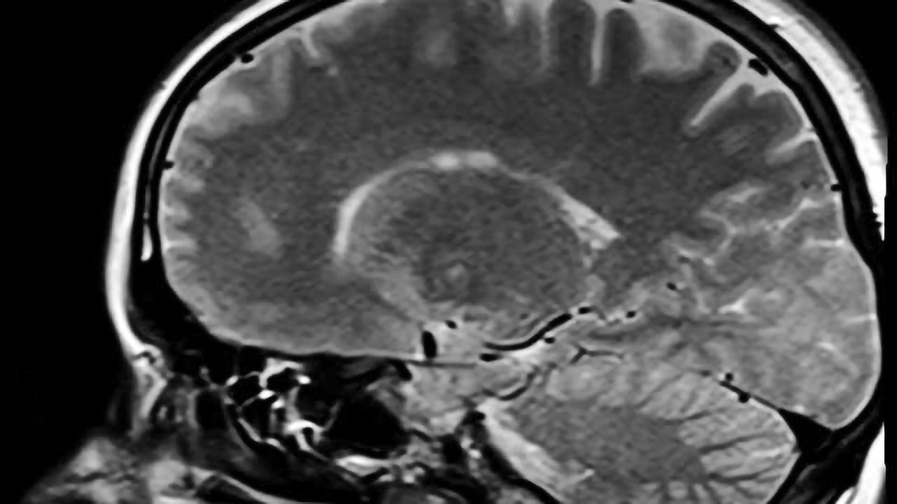 'Mindful People' Feel Less Pain; MRI Imaging Pinpoints Supporting Brain Activity