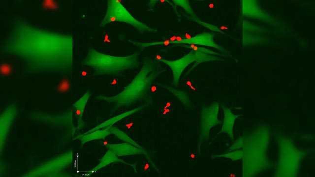“Signposts” on Cancer Cells May Help Immune Cells Eliminate Melanoma