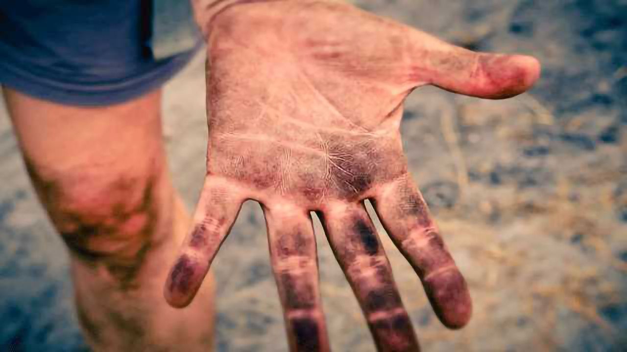 Study Identifies Skin Origins, Could Lead to Better Grafts
