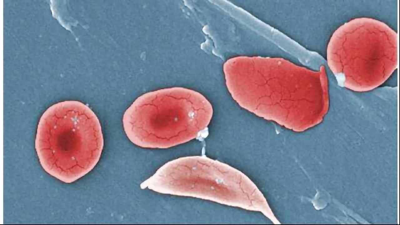 NIH Targets Genetic Cure for Sickle Cell Disease