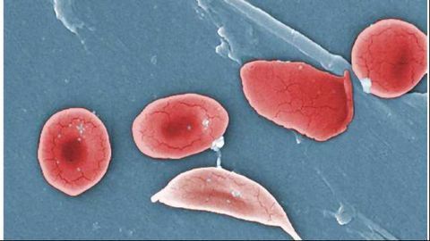 NIH Targets Genetic Cure for Sickle Cell Disease
