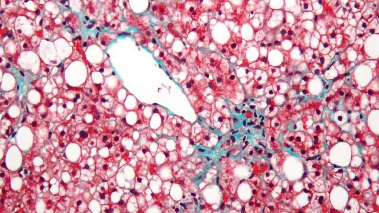 Fatty Liver Disease Affects Cells' Energy Factories