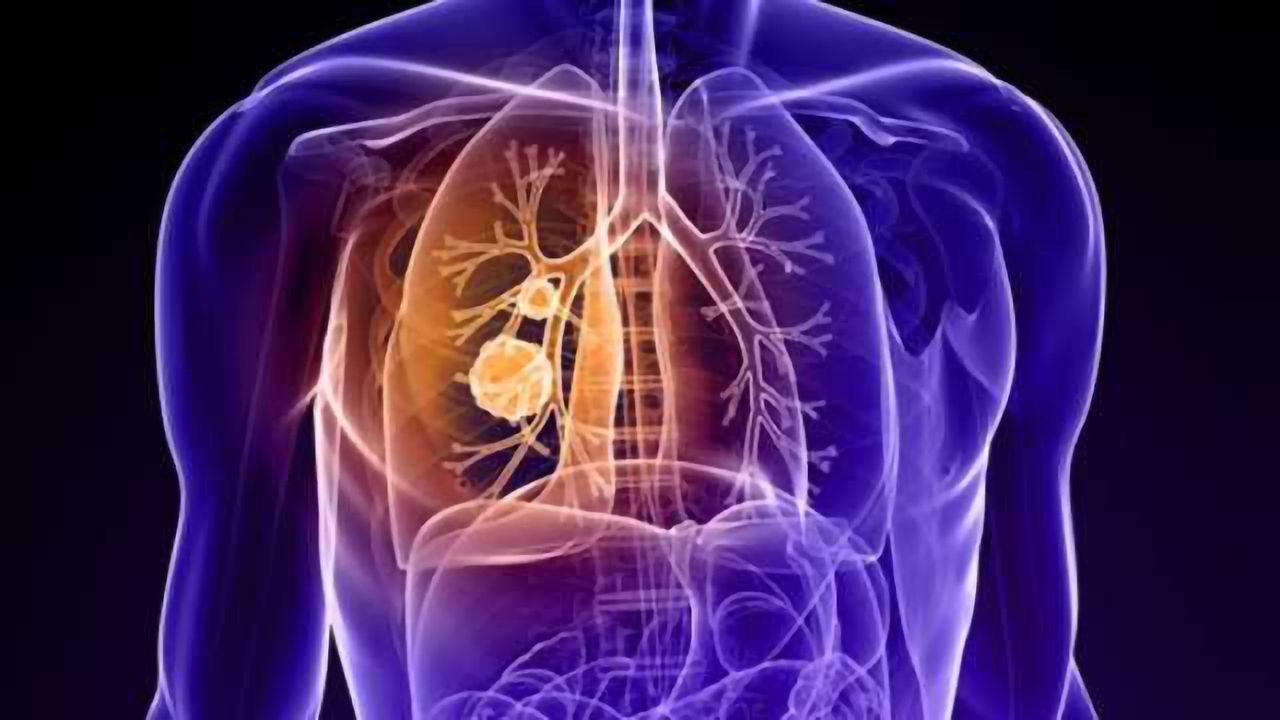 Using AI to ID Lung Cancer Types