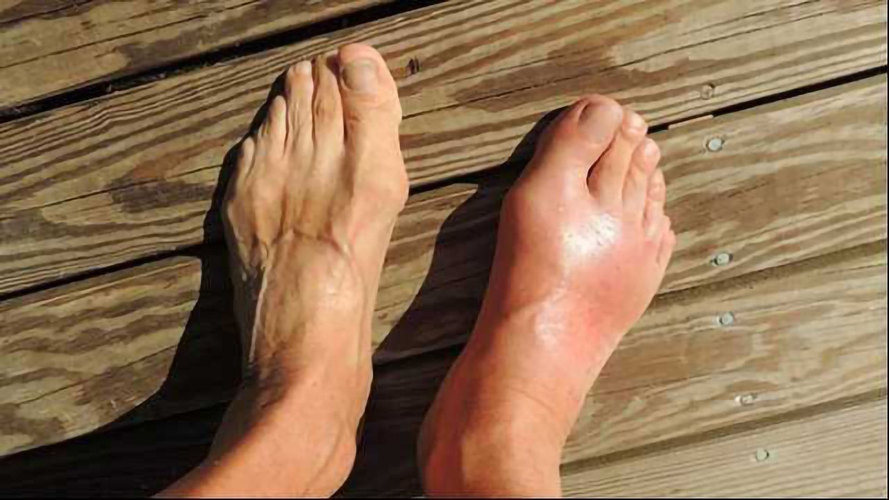Gout Get Outta Here