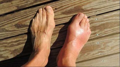 Gout Get Outta Here