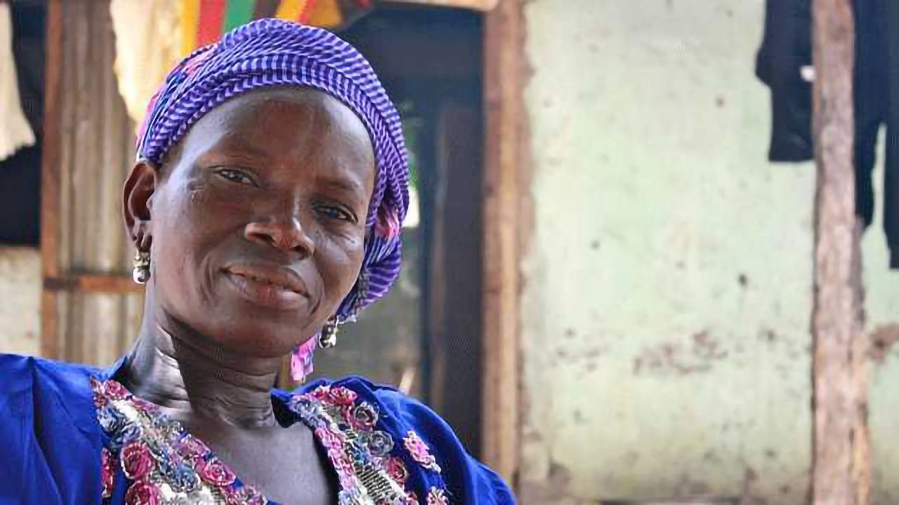 Lupus Antibody Study Should Lead to Better Diagnoses for Black Africans