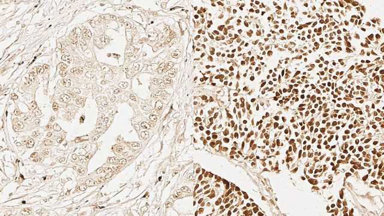 Genetic Similarities Found Across Multiple Cancer Types