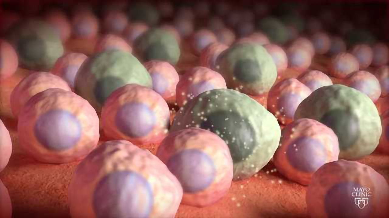 Zombie Cells Identified in Alzheimer's Brains