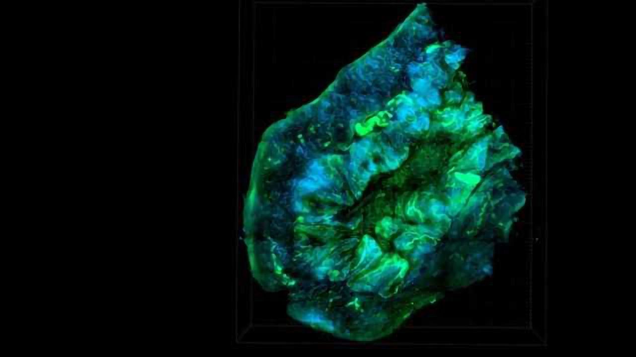Ovarian Cancer Biomarker Can Predict Patient Therapy Response