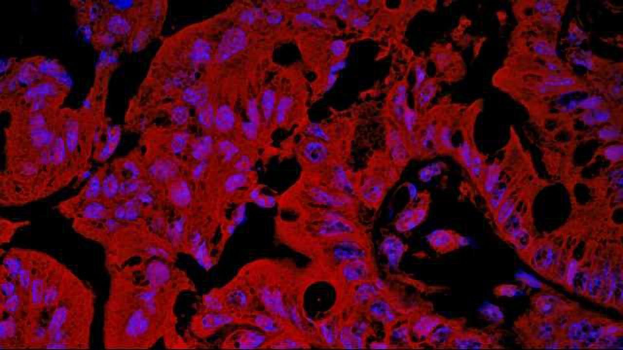 Epigenetic Signature May Help People Stay Ahead of IBD