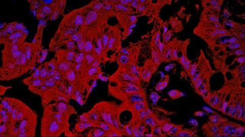 Epigenetic Signature May Help People Stay Ahead of IBD
