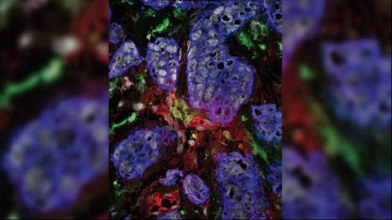 Cytokine Signature Helps Target Advanced Breast Cancer
