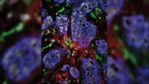 Cytokine Signature Helps Target Advanced Breast Cancer