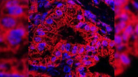 Drug Blocks Pancreatic Cancer Growth in Mice