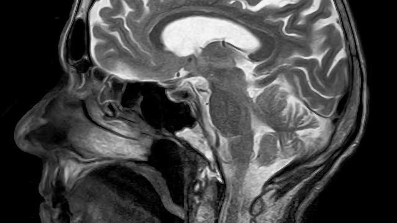 New Molecule Capable of Halting and Reverting Neurodegeneration Caused by Parkinson's Disease