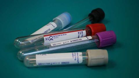 Urine RNA May Provide Muscular Dystrophy Biomarkers