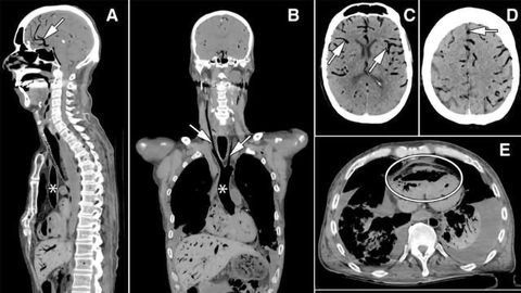 Postmortem Diagnosis Improved by Minimally Invasive Techniques