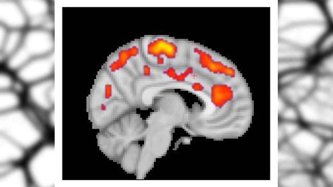 Glial Activation Found in the Brains of Fibromyalgia Patients