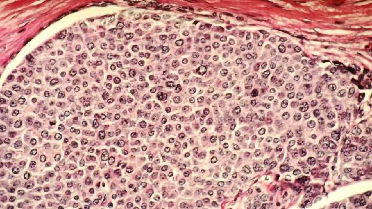 3D Breast Cancer Models Introduce Stromal Cells as New Drug Therapy Targets