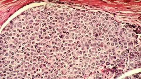 3D Breast Cancer Models Introduce Stromal Cells as New Drug Therapy Targets