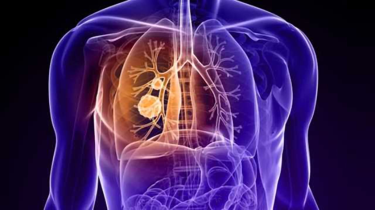 Two-Pronged Approach Reveals Drug Combination for Lung Cancer