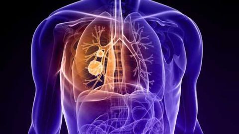 Two-Pronged Approach Reveals Drug Combination for Lung Cancer