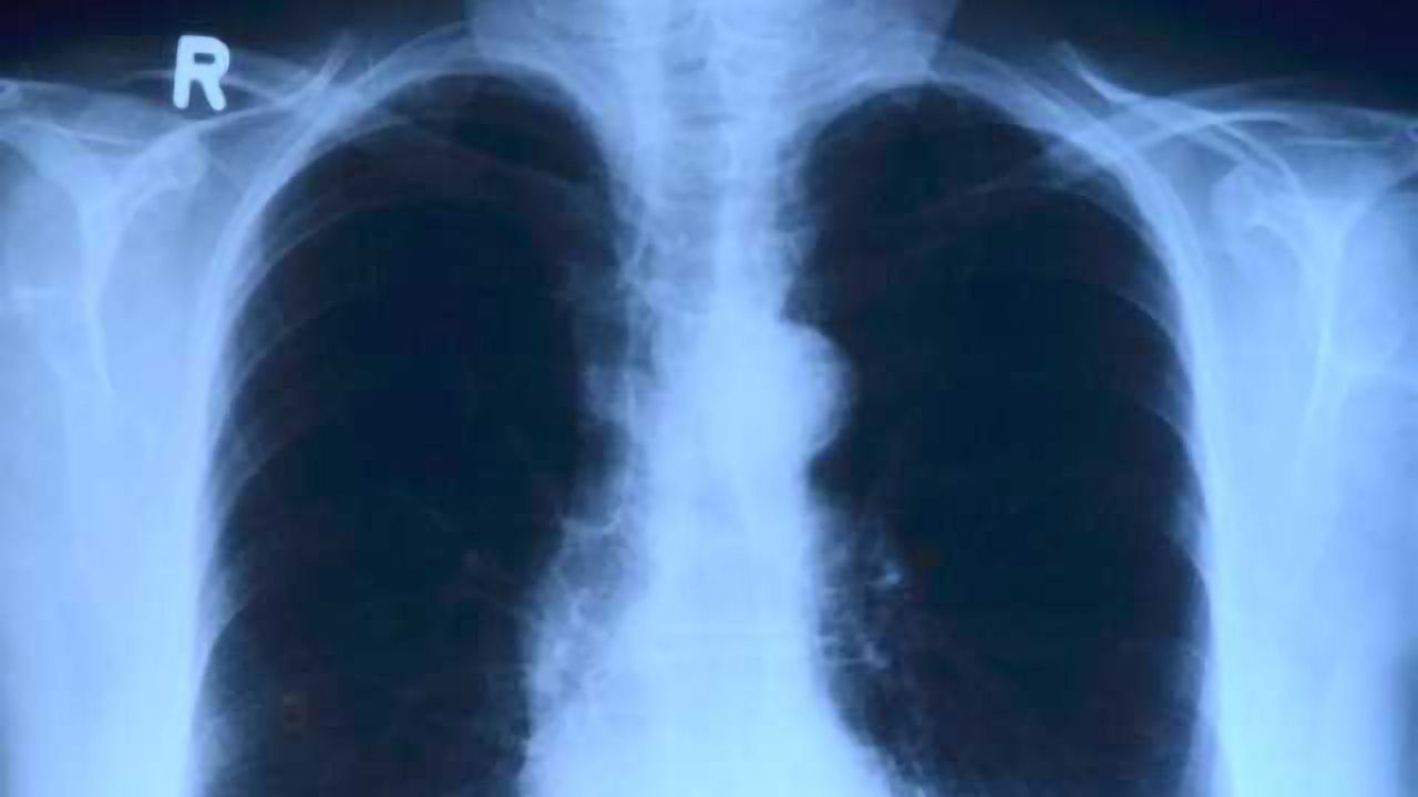 Unraveling TB's Genetic Code Could Improve Treatment Strategies