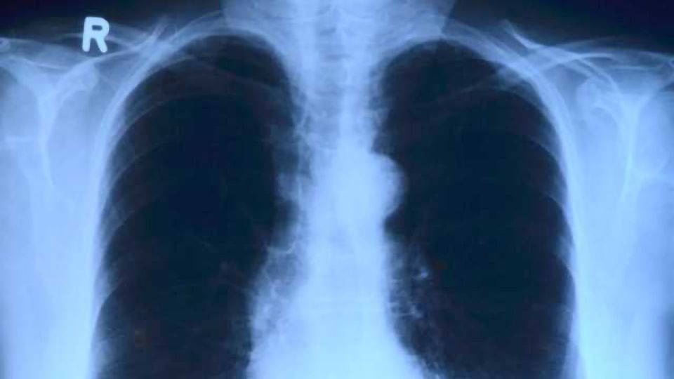 Unraveling TB's Genetic Code Could Improve Treatment Strategies content piece image