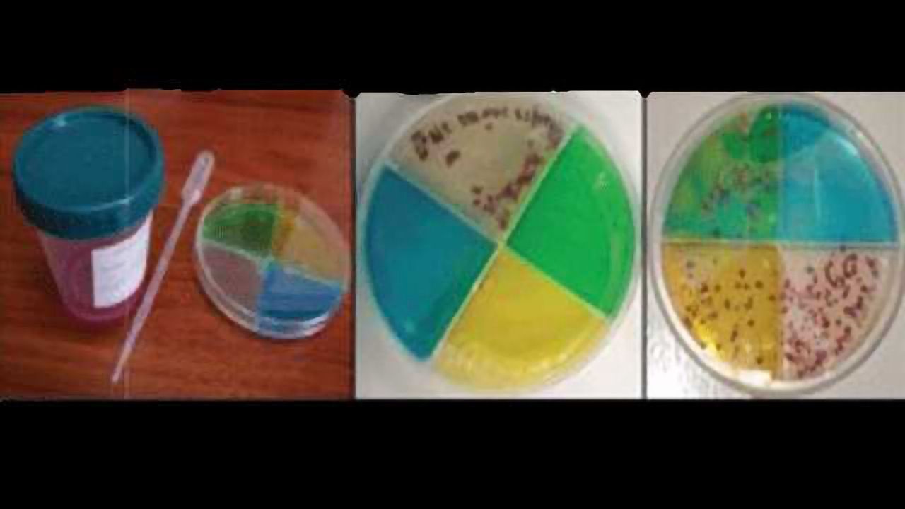 Inexpensive TB Test Holds Promise for Low-income Countries
