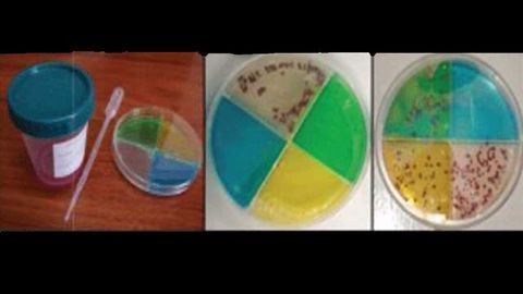Inexpensive TB Test Holds Promise for Low-income Countries