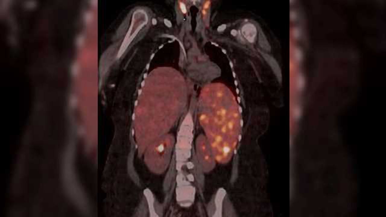 Technique Highlighted, Helps Doctors Avoid Mistaking Cancer for Immune Disorder