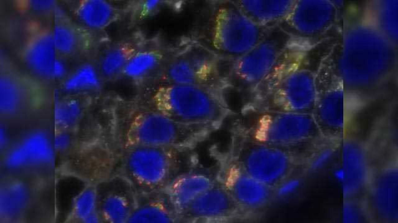 Nanoparticle-Encased Drug Shows Promise as Triple-Negative Breast Cancer Therapy