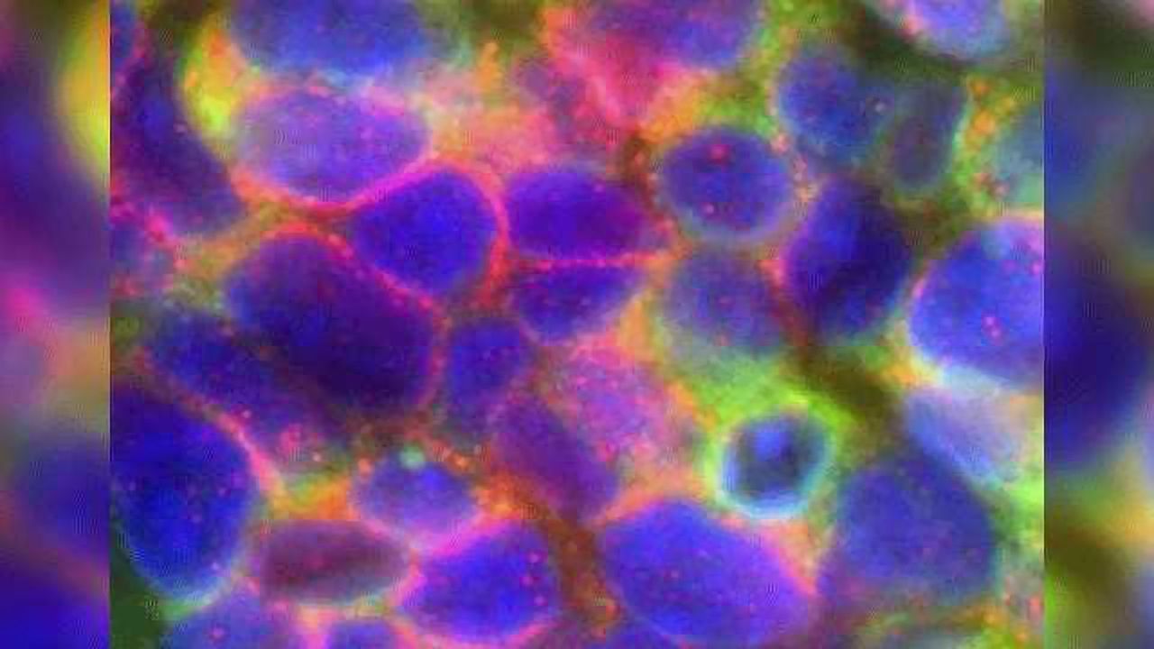 Aggressive Prostate and Lung Cancers Have a Common Denominator
