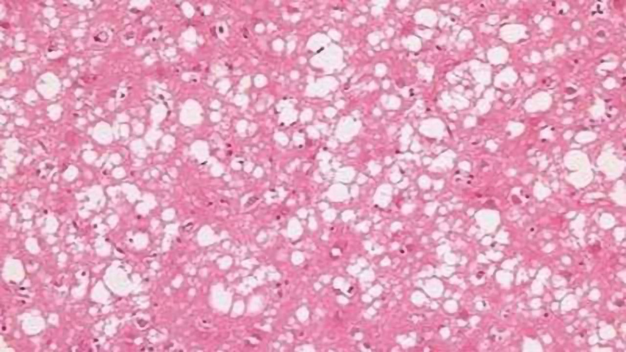 Pioneering Treatment to be Given to CJD Patient for the First Time