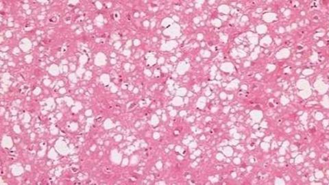 Pioneering Treatment to be Given to CJD Patient for the First Time