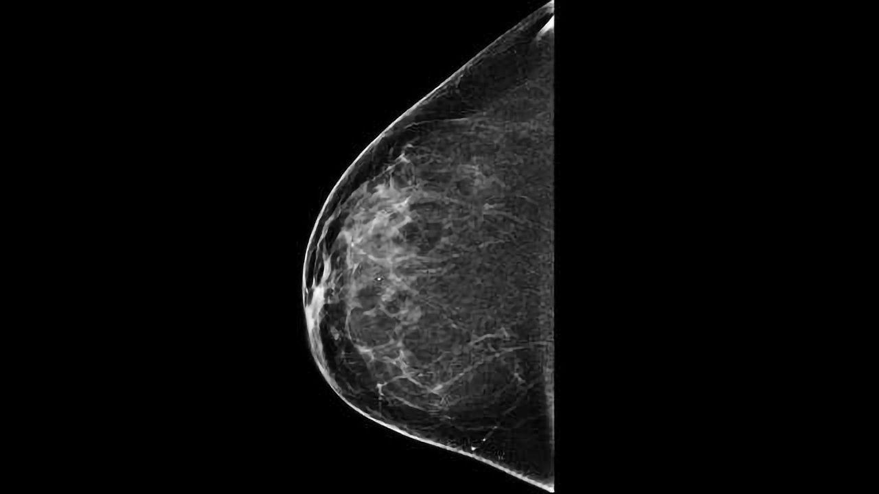 Deep Learning Catches Out False Positive Mammograms