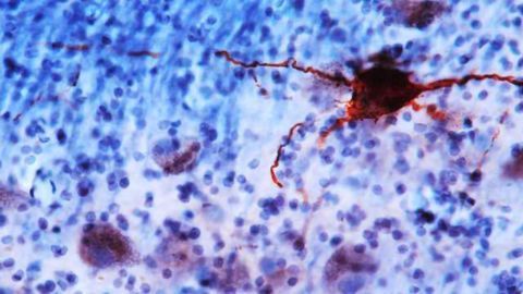 Study Suggests Biological Basis for Depression, Anxiety and Sleep Disturbances in Older Adults