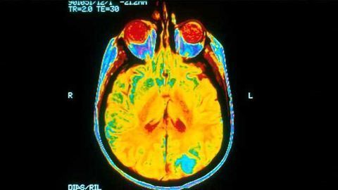 Compound Could Target Protein Linked to Childhood Brain Cancer