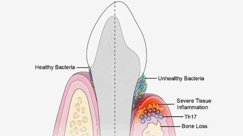 Immune Culprits Linked to Inflammation and Bone Loss in Gum Disease